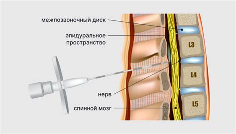 Движущиеся роды: в Бельгии представили «активную» эпидуральную анестезию