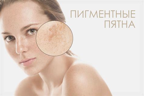 Естественные методы борьбы с пигментацией при беременности